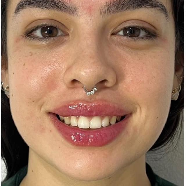 Depois — sorriso gengival