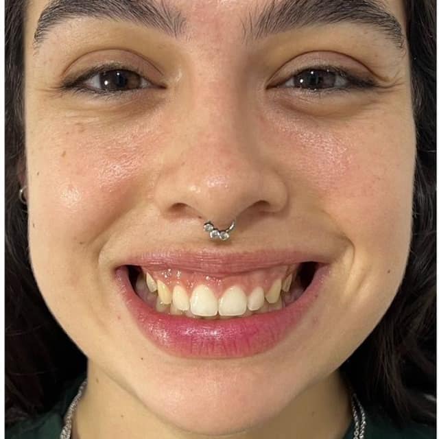 Antes — sorriso gengival